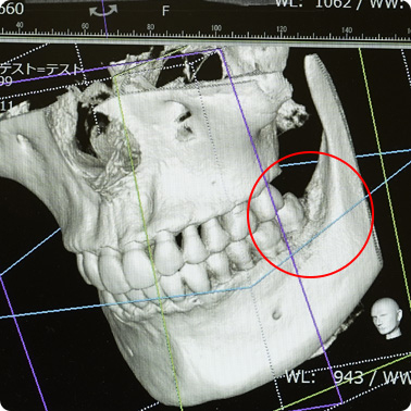 CTレントゲンによる３D撮影｜福岡県西区のないとうファミリー歯科クリニック
