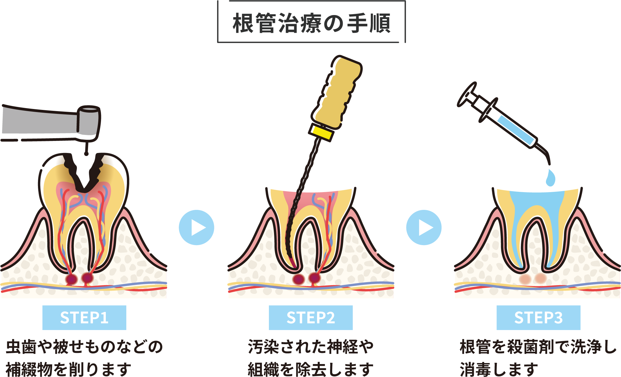 根管治療の手順