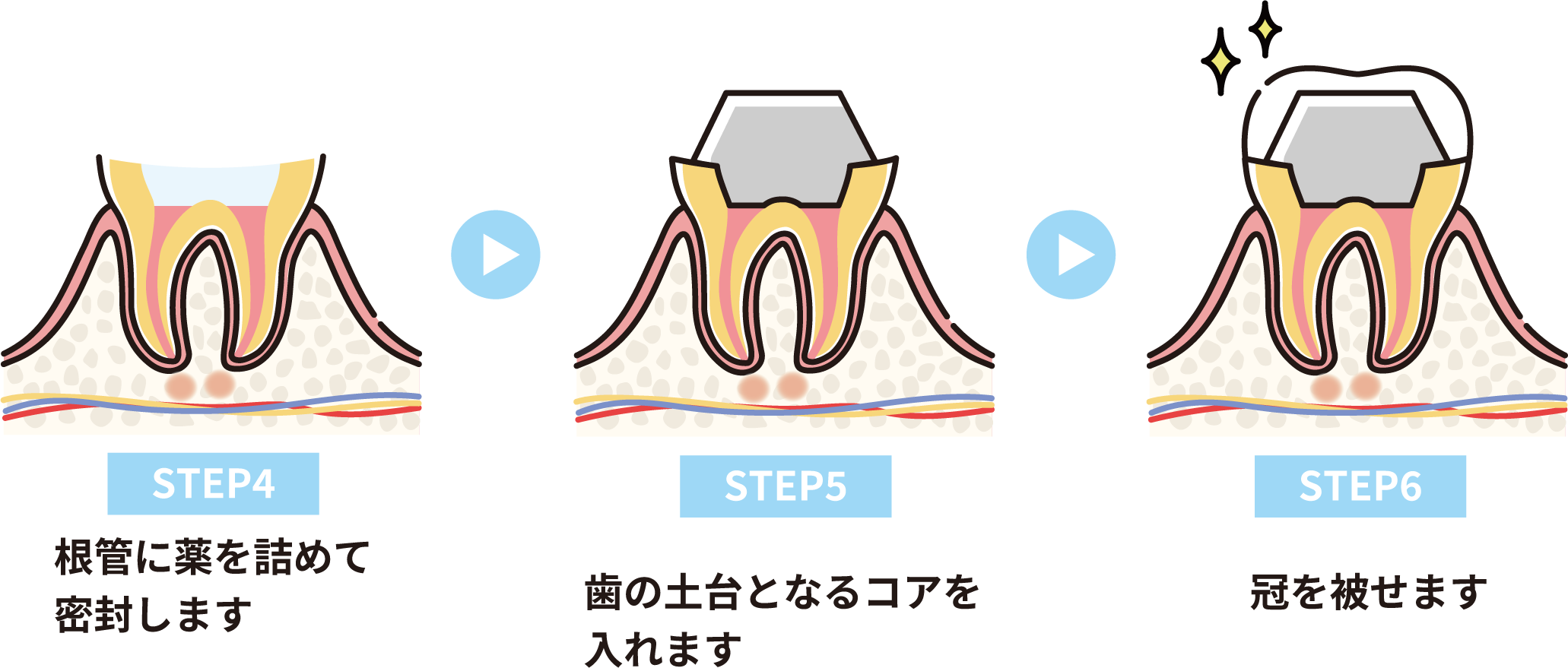 根管治療の手順