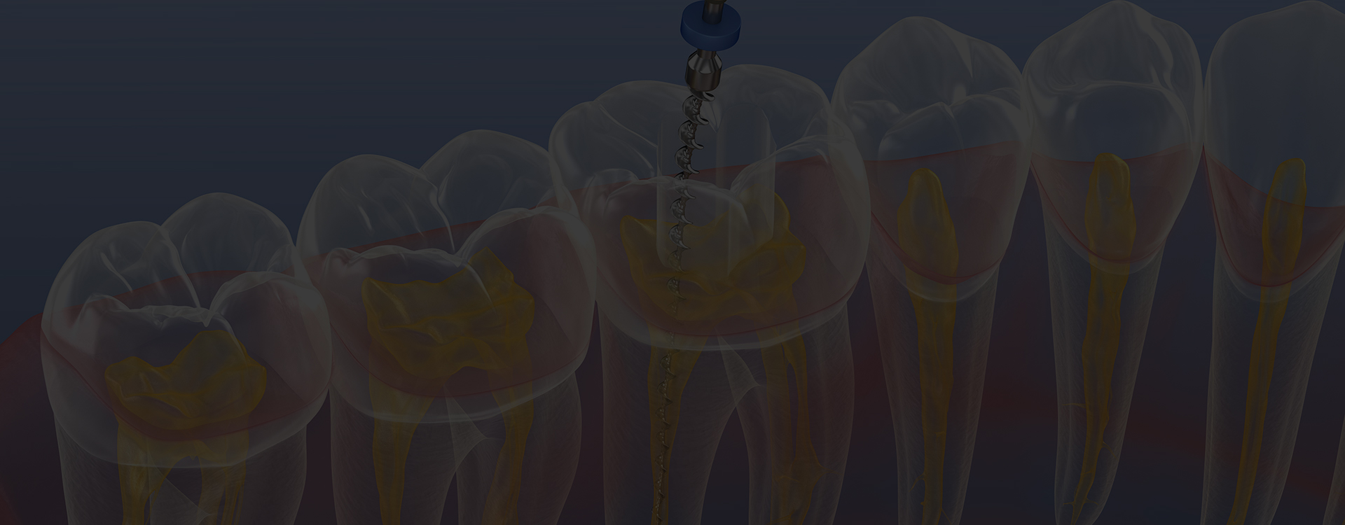 ないとうファミリー歯科クリニックの精密根管治療