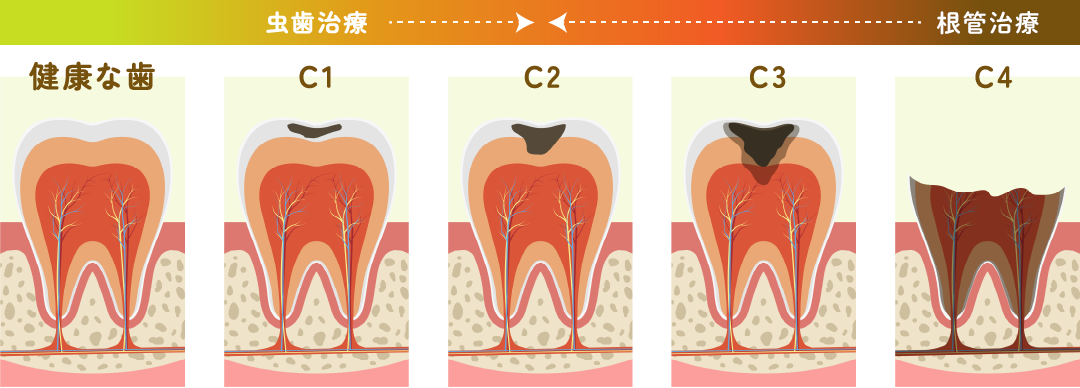 根管治療の順番
